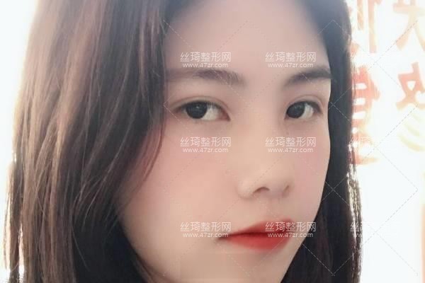 上海九院怎么樣？雙眼皮3個月果|整形專家詳情