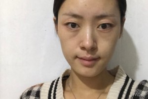華康整形醫(yī)院正規(guī)嗎？隆鼻成功案例&費(fèi)用表