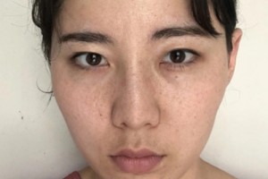 浙一激光美容科？真人實拍對比&費用表