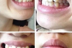 西安中諾口腔醫(yī)院評(píng)價(jià)？牙齒矯正成功案例分享！