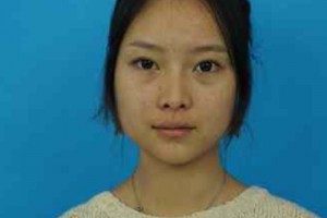 濟南華僑醫(yī)院雙眼皮咋樣？醫(yī)生技術(shù)如何/費用表