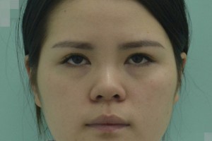 南京鼓樓醫(yī)院激光價格表—案例對比圖