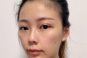 南方醫(yī)院苗勇植發(fā)果好不好？真實案例分享