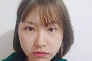無錫二院的美容科好嗎？假體隆鼻術(shù)后恢復(fù)|價(jià)格表