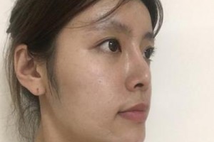 京民整形醫(yī)院假體隆鼻靠譜嗎？親身經(jīng)歷分享&對比圖