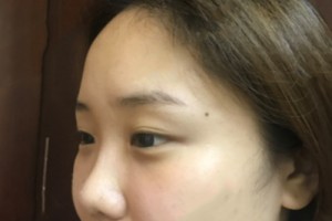 武漢協(xié)和醫(yī)院美容科怎么樣 ？去眼袋果圖