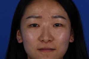 上海伊萊美容醫(yī)院口碑怎么樣？雙眼皮案例對比圖