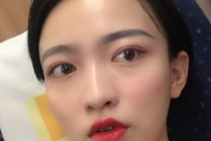 惠州中心醫(yī)院整形美容祛斑果？術(shù)后注意事項必看