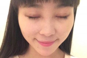 臨沂市人民醫(yī)院雙眼皮怎么樣？注意事項(xiàng)+術(shù)前準(zhǔn)備必看