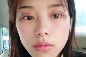 長(zhǎng)沙亞韓整形醫(yī)院雙眼皮價(jià)格？術(shù)后幾點(diǎn)需注意！