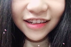 江蘇邳州口腔靠譜嗎？牙齒矯正的價(jià)格表!