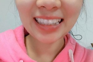 長(zhǎng)沙市口腔醫(yī)院牙齒矯正多少錢？案例測(cè)評(píng)+價(jià)格表