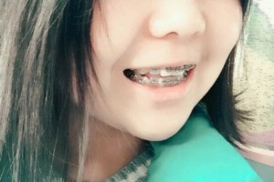 四川華西口腔醫(yī)院？牙齒矯正術(shù)后分享！