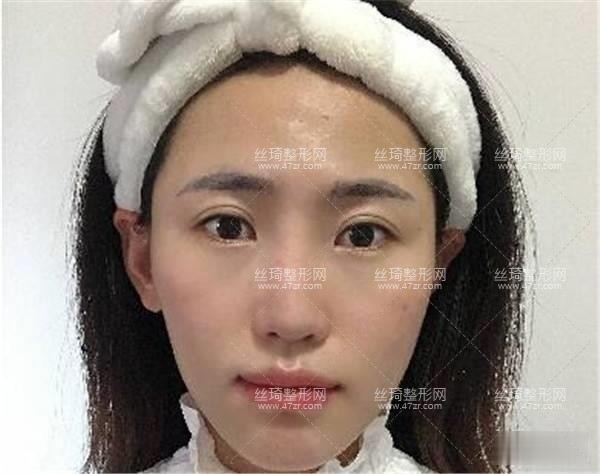 上海第九人民醫(yī)院整形怎么樣？隆鼻案例圖|價(jià)格費(fèi)用