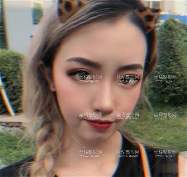 304醫(yī)院整形美容科怎么樣隆鼻3個月果|整形專家詳情