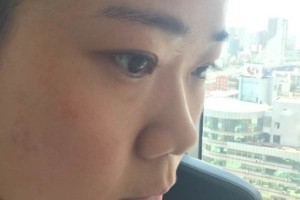 成都恩喜整形醫(yī)院膨體隆鼻正規(guī)嗎？醫(yī)生推薦