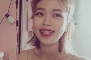 北京勁松口腔醫(yī)院/牙齒矯正成功案例分享