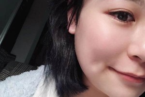 安醫(yī)二附院整形外科下頜角怎么樣？成功案例測評！