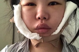 鄭大一附院有整形科怎么樣？下頜角術(shù)真實(shí)案例|醫(yī)生推薦