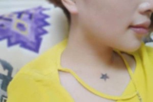 浙江張小紅美容醫(yī)院下頜角較新價格表|案例分享