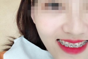 青島優(yōu)諾博士口腔醫(yī)院牙齒矯正怎么樣？恢復(fù)圖分享