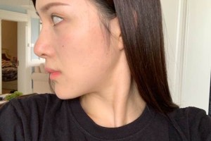 廈門第一醫(yī)院美容科下頜角怎么樣？術(shù)前術(shù)后對比圖！