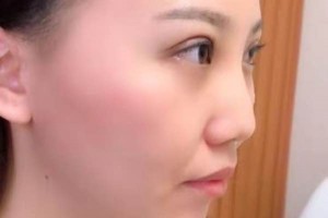 廈門第一醫(yī)院整形科哪位醫(yī)生好？埋線雙眼皮術(shù)后果&價格表