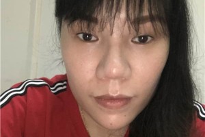 無錫人民醫(yī)院膨體隆鼻怎么樣？真實案例分享！