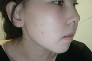 協(xié)和醫(yī)院整形科硅膠隆鼻價(jià)位？真實(shí)案例分享！