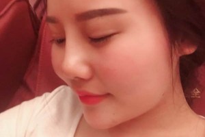 深圳北大醫(yī)院美容科膨體隆鼻好嗎？真實案例分享！