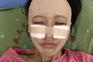 上海安縵醫(yī)療怎么樣？面部填充成功案例測評！