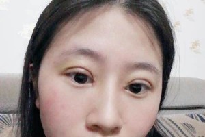 南昌大學美容醫(yī)院切開雙眼皮是正規(guī)嗎？附果圖&價格表