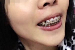 北京億大口腔醫(yī)院牙齒矯正怎么樣？附較新價(jià)格表！