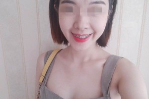 南京口腔醫(yī)院牙齒矯正哪個醫(yī)生好/真實案例對比！