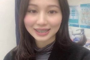 濟(jì)南圣貝口腔醫(yī)院牙齒矯正怎么樣/真實(shí)案例對(duì)比！