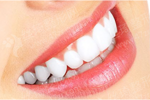 西安做美容冠醫(yī)院排行榜醫(yī)院實力簡介|美容冠項目術后案例評價_醫(yī)院優(yōu)勢